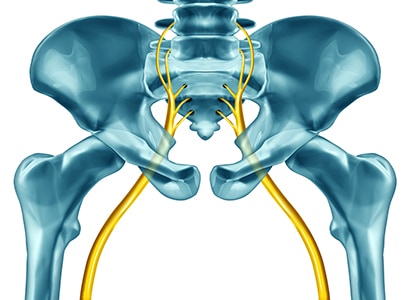 Non-Surgical Treatment for Sciatic Nerve Pain Relief Bellingham, WA